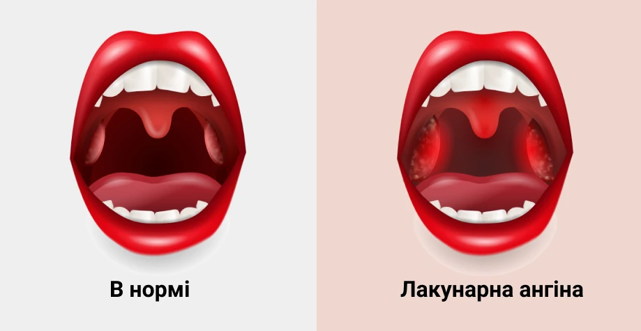 Як лікувати ангіну: що працює насправді